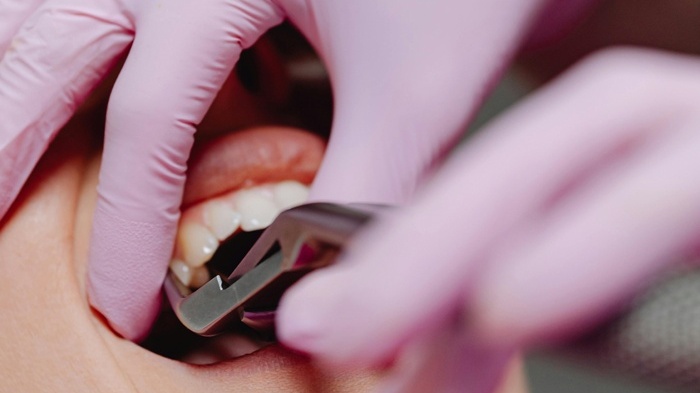 莱沃口腔‖拔牙，可不是你想拔就能拔的！