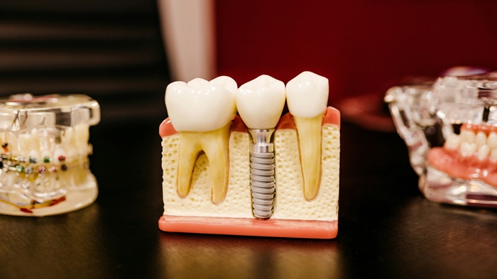 莱沃口腔‖缺牙的坏处竟然这么多？幸好这几种方式能补救