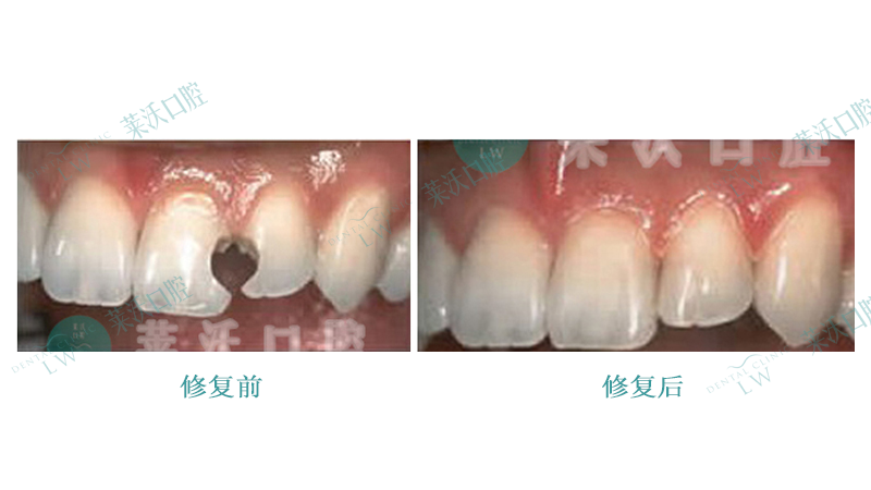 树脂光敏对比照