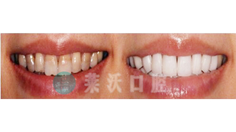 瓜子牙